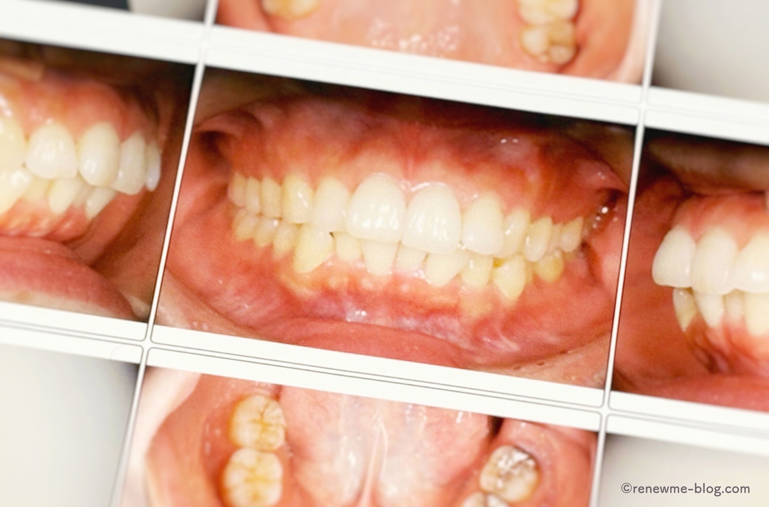 精密検査時に撮影した口腔内写真