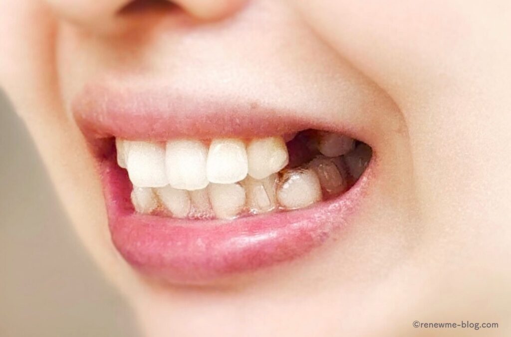 抜歯後の歯左側