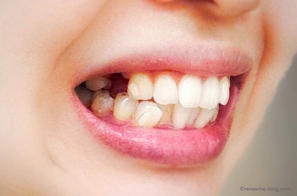 抜歯後の歯右側