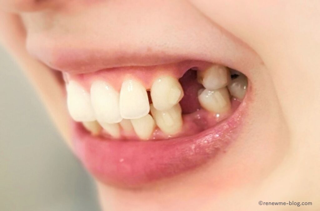 抜歯後の歯左側