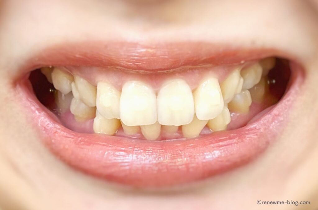 半年後(正面から)